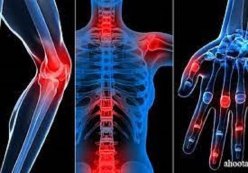 آرتروز بیماری فراگیر