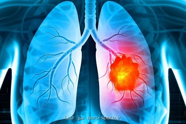 درمان تغییرات ایجادشده در میکروبیوم ریه بر اثر سیگار کشیدن