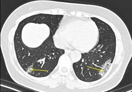 تركیب گیاهی جهت پیشگیری از تنگی نفس در بیماران كرونا تهیه شد